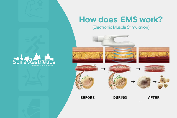 EMS treatment for post pregnancy weight loss treatment Woburn Sands