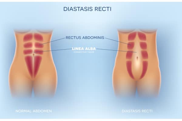 What Non-Surgical Options Are Available for Diastasis Recti Woburn Sands?