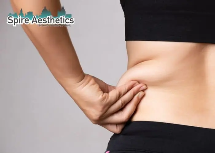 Image of woman pinching fat on their hips Woburn Sands. Fat Freezing treatment 