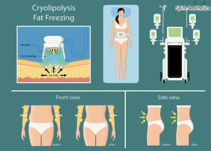 Fat freezing treatment Woburn Sands benefits for competitions to remove stubborn fat deposits.