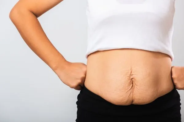 Image of a woman's stomach after weight loss with sagging skin following a gastric band Woburn Sands