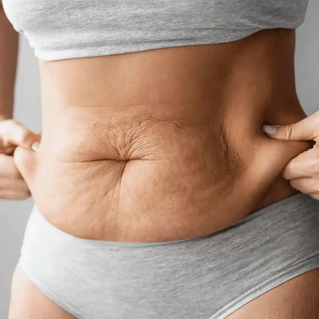 Is It Normal to Have Loose Skin After Pregnancy Woburn Sands?