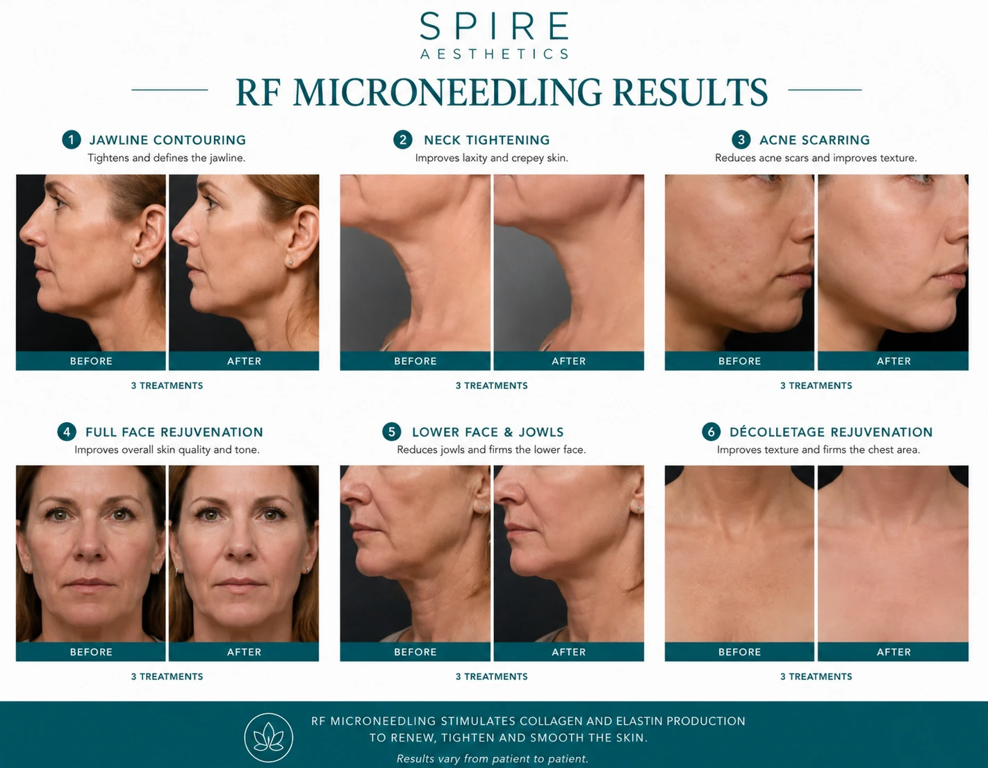 RF Microneedling Skin tightening Woburn Sands results