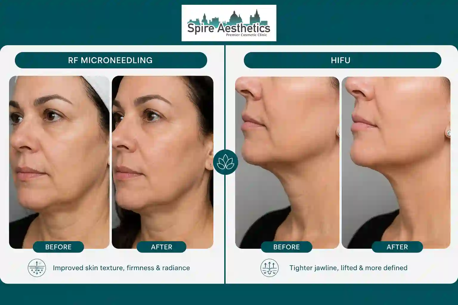 Can RF Microneedling and HIFU Be Combined Woburn Sands?