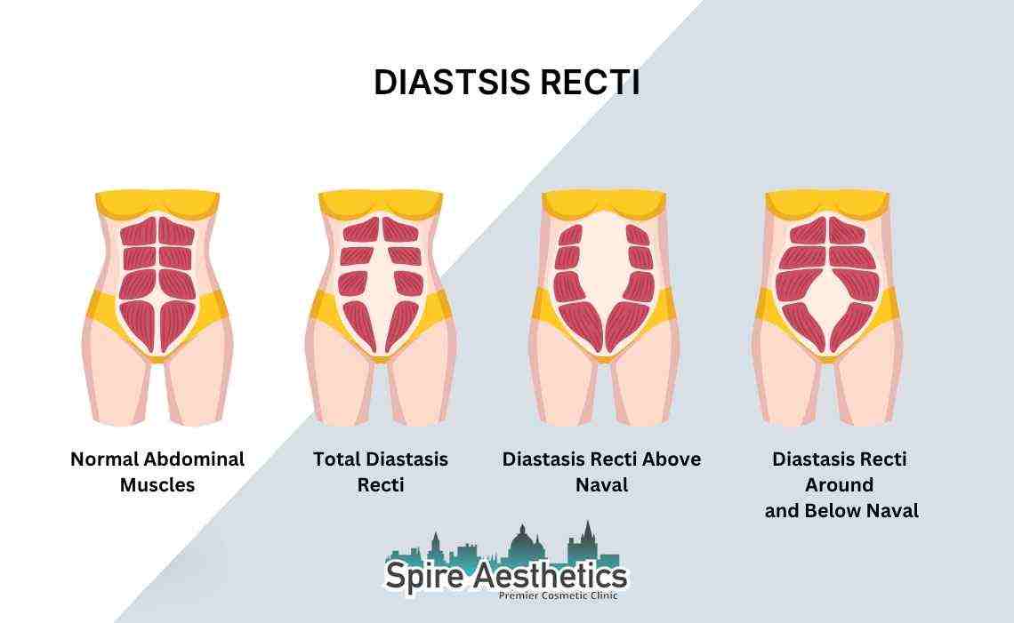Is Non-Surgical Diastasis Recti Treatment Right for You? Common Concerns Answered Woburn Sands